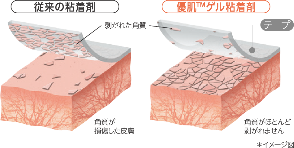 角質保護システム 優肌™ゲル粘着剤は、貼付・剥離による物理的な刺激（角質層の損傷）を抑えます。従来の粘着剤が貼り替え時に角質層まで剥離し、痛みやかぶれの原因となるのに対し、優肌™ゲル粘着剤は、軟らかく皮膚の凹凸になじみやすく、優しく剥離することができます。